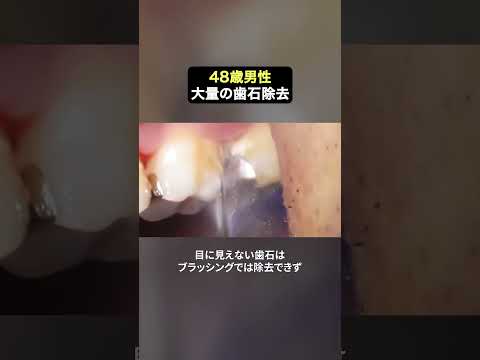 長時間集中歯石除去‼️ #ザホワイトデンタルクリニック  #歯医者  #歯石除去