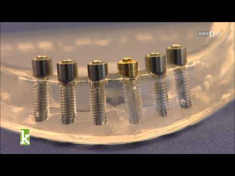 Konkret Reportage - Mini Implantate als billiger Zahnersatz