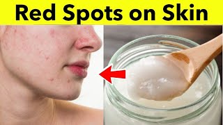 How to Remove Red Spots on Face | Natural Home Remedies to Get Rid of Red Spots| Hyperpigmentation