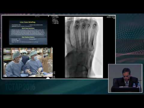 [Endovascular Symposium] Live Case Session II. Below the Knee or SFA Intervention
