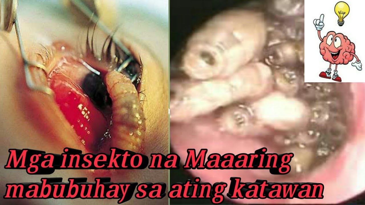 Mga insekto na maaaring mabubuhay sa ating katawan