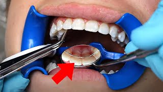 Permanent RETAINERS !!... How do they work? | McKinney Orthodontist