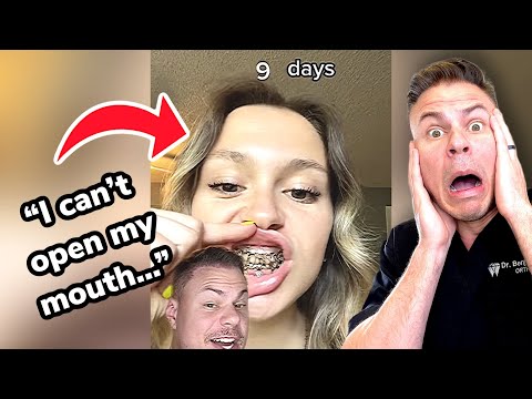 Orthodontist Reacts! Girl Hit By Softball Breaks Jaw