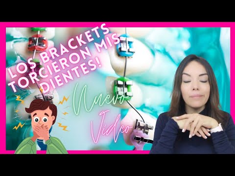 La ORTODONCIA torció mis DIENTES?