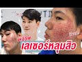 สจ๊วตพลีชีพ EP.3 ยอมหน้าพัง 2 อาทิตย์ ทำเลเซอร์รักษาหลุมสิวที่ได้ผลที่สุด| ไปอยู่ไหนมา