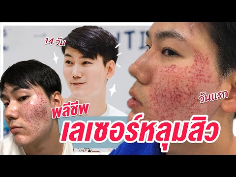 สจ๊วตพลีชีพ EP.3 ยอมหน้าพัง 2 อาทิตย์ ทำเลเซอร์รักษาหลุมสิวที่ได้ผลที่สุด| ไปอยู่ไหนมา สจ๊วตพลีชีพ EP.3 ยอมหน้าพัง 2 อาทิตย์ ทำเลเซอร์รักษาหลุมสิวที่ได้ผลที่สุด| ไปอยู่ไหนมา