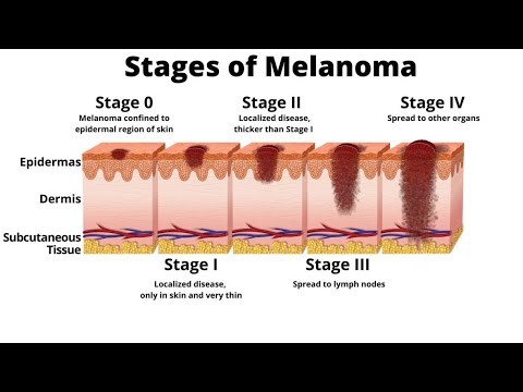 Melanoma not knowing results is the biggest battle part three of 3 for 3