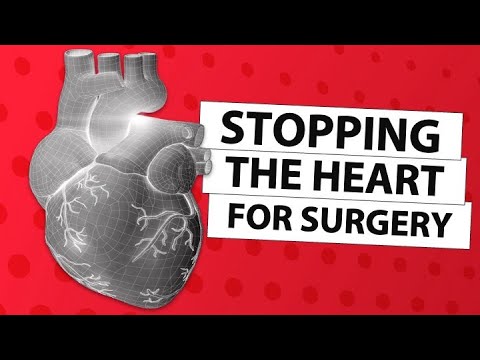 Surgeon Q&A: Stopping The Heart During Cardiac Surgery