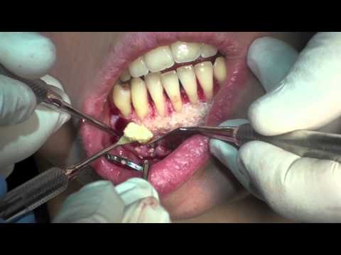 Periodontally Facilitated Orthodontics