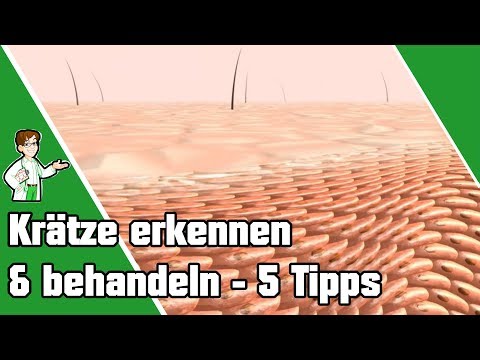 Krätze erkennen und behandeln - Top 5 Tipps 📌