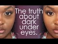 TREATING DARK CIRCLES PUFFY UNDEREYES Causes Treatments An Esthetician S Guide
