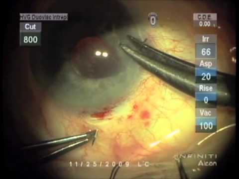 Fijación de sutura del complejo LIO dislocado a través de CCC fibrótico