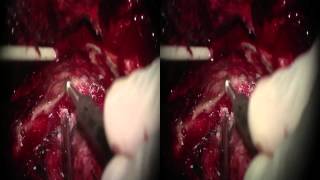 Download Lagu Anterior Transpetrosal Approach for Resection of Recurrent Skull Base Chordoma Thumbnail