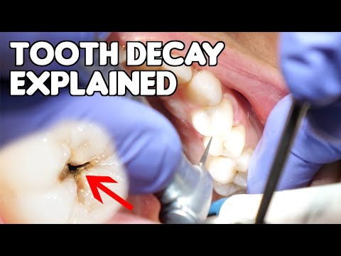 Tooth Decay (Cavity) Explained | Cavities vs Fillings vs Dental Caries