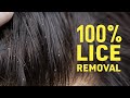 Get Rid Of Lice COMPLETELY Safe Natural Home Remedies For Lice Nits