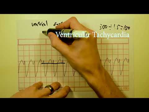 ECG/EKG interpretation (basics) COURSE Part 2 of 3 ~  12 lead ECG analysis.