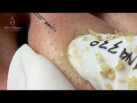 Loan Nguyen Acne Treatment (#146)