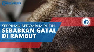 Serba-serbi Ketombe, Serpihan Berwarna Putih Keabu-abuan atau Kekuningan yang Menyebabkan Rasa Gatal