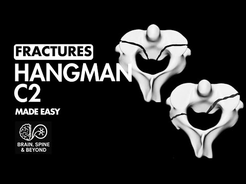 C2 Hangman Fracture Everything You Need to Know: Mechanism, Classification, imaging and Treatment