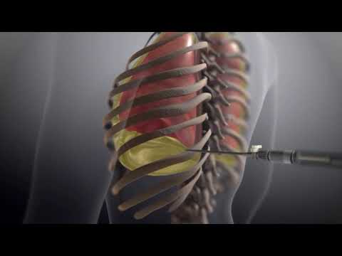 ¿CÓMO SE TRATA LAS EFUSIONES PLEURALES?