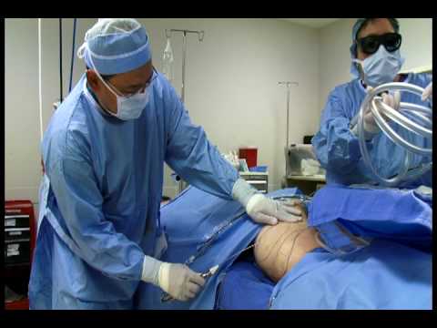 download lagu mp3 mp4 Smartlipo Cleveland Ohio, download lagu Smartlipo Cleveland Ohio gratis, unduh video klip Smartlipo Cleveland Ohio