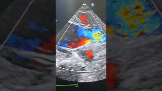 Download lagu #ar #2decho #aortic_valve_insufficiency #cardiacrehab #cardiology #biology #heart mp3 Download lagu #ar #2decho #aortic_valve_insufficiency #cardiacrehab #cardiology #biology #heart mp3