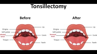 Tonsillectomy CPT  code - simplify medical coding