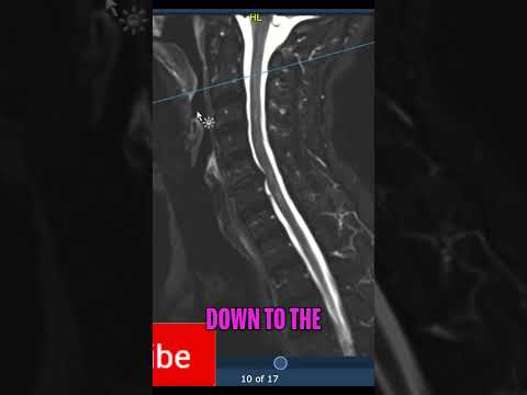 Spotting MS Spinal Lesions  MRI Scan Analysis