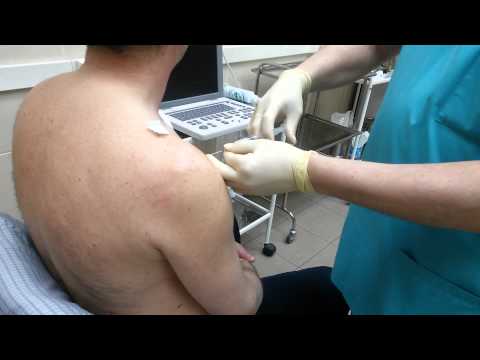 Лечение боли в плечевом суставе блокадой с дипроспаном