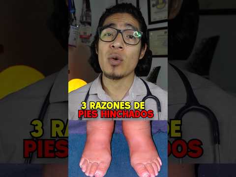 Why do feet swell? #edema #medicine #health