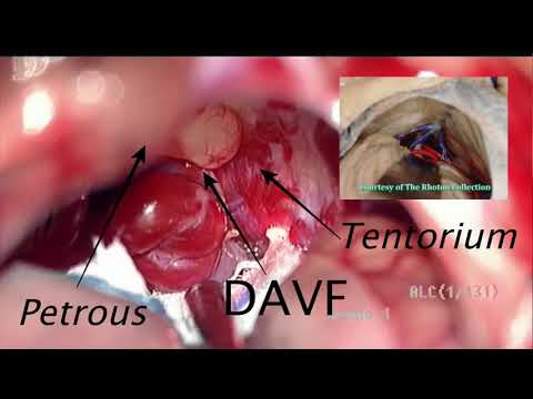 Surgical Clipping of a Petrosal Tentorial Dural Arteriovenous Fistula (Lawton's Type 5)