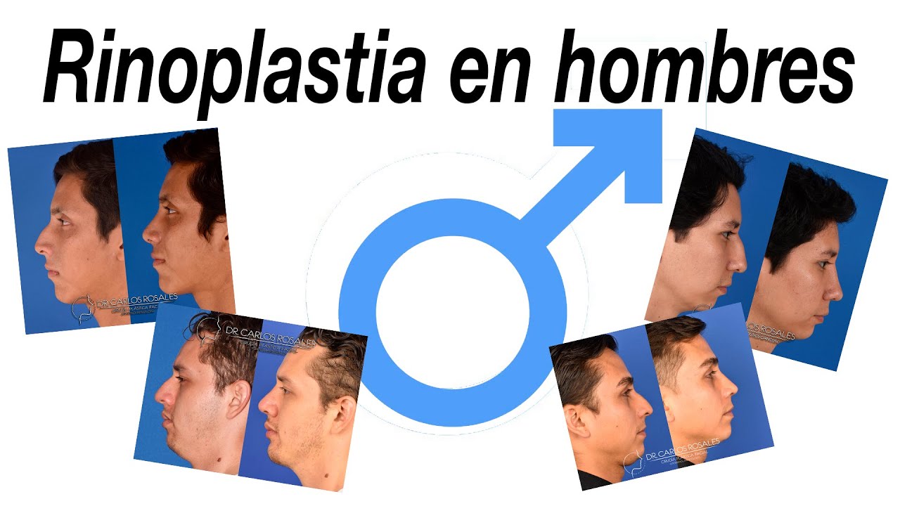 Watch Rinoplastia en hombres Now Rinoplastia en hombres