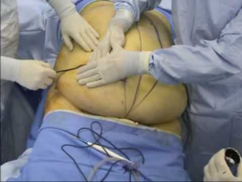 Crema per la psoriasi sul pene Effetto zucca su potenza