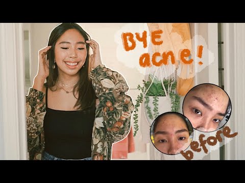 how i got rid of my acne