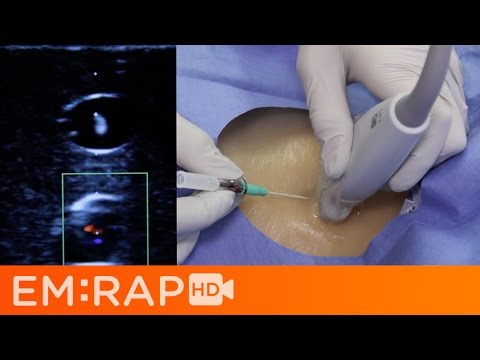 Rapid IJ (aka Easy Internal Jugular Cannulation)