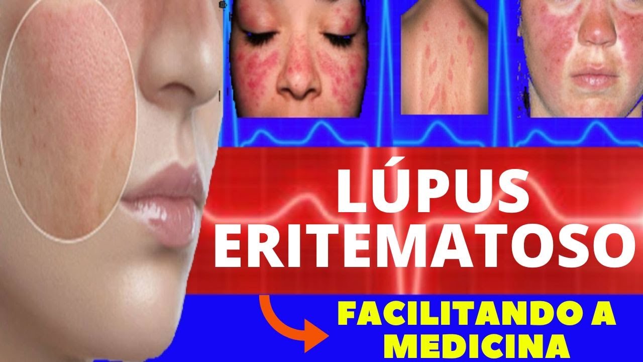LÚPUS ERITEMATOSO - O QUE É, CAUSAS E SINTOMAS, DIAGNÓSTICO E TRATAMENTO - TUDO SOBRE LÚPUS