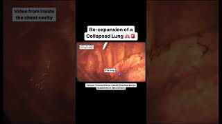 Collapsed Lung Re-expanding via Needle Decompression