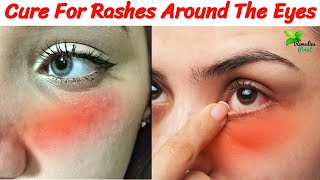 Home Remedies To Get Rid Of Rash Around The Eyes | Home Remedies For Itching Rashes