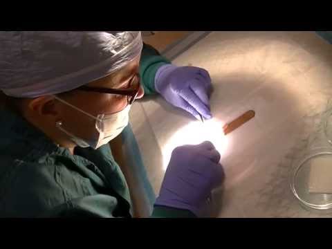 Les étapes de la chirurgie en vidéo