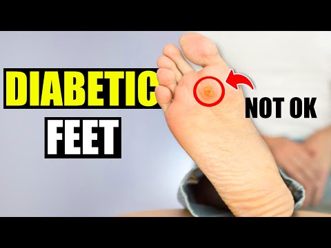 How to Take Care of Diabetic Feet & Avoid Neuropathy