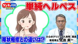 単純ヘルペス 帯状疱疹との違いは？