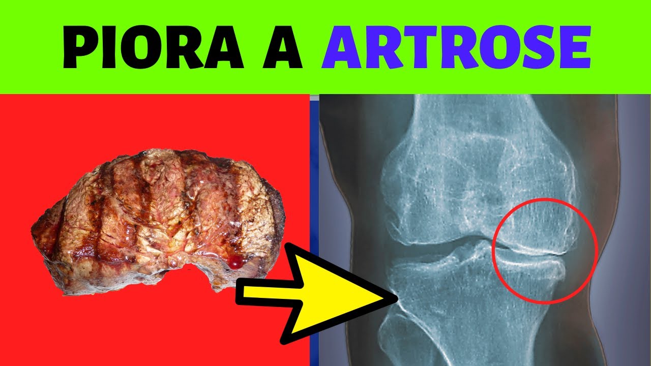 ARTRITE E ARTROSE - 3 ALIMENTOS QUE PODEM PIORAR SUAS DORES