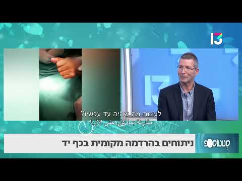 ניתוחים בהרדמה מקומית בכף היד