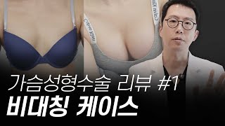 가슴성형 리뷰 Case.01 : 비대칭, 이중평면, 멘토 엑스트라