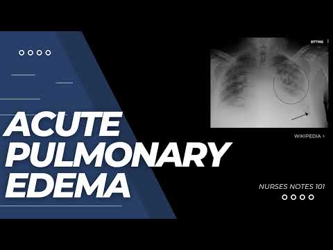 Acute Pulmonary Edema: CARDIOLOGY Nursing