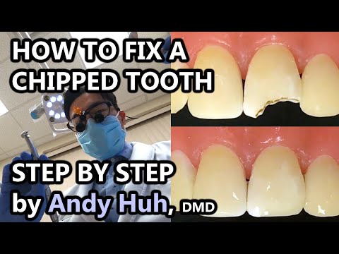 How to fix a chipped/broken tooth, dental bonding, composite Pasta Evergreen Dental, Billerica, MA