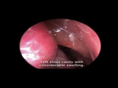 Polyp Reduction in the Office Using Local Steroids