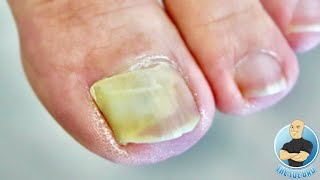 DAMAGED BIG TOENAIL COMPLETELY LIFTED!!! **HOW TO TREAT LIFTED TOENAILS**