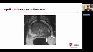 Innovative screening options to catch prostate cancer early
