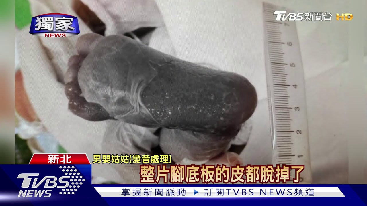 男嬰「腳、臀」二度燙傷15% 母崩潰控醫院隱瞞